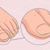 Guérir un ongle fongique