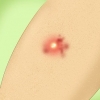 Traiter une infection staphylococcique