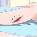 Traiter la cellulite