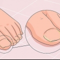 Guérir un ongle fongique