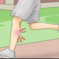 Traiter les crampes de chaleur