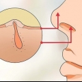 Traiter les poils du nez incarnés