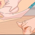 Traiter les pieds de tranchée