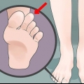 Faire face au pied grec (syndrome de morton)