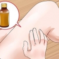 Traiter la teigne : peut-elle naturellement?