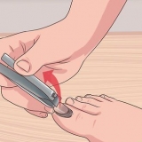 Traiter un ongle déchiré