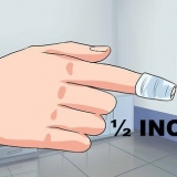 Traiter un ongle incarné