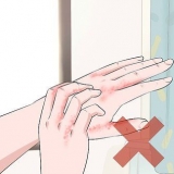 Reconnaître une infection fongique