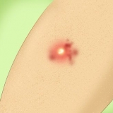 Traiter une infection staphylococcique