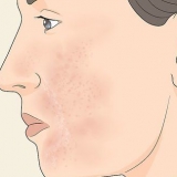 Guérir la peau trop exfoliée