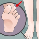 Faire face au pied grec (syndrome de morton)
