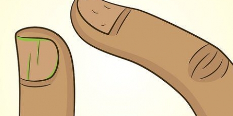 Guérir les ongles abîmés