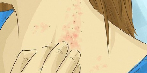 Traiter les infections fongiques de la peau : peut-il naturellement?