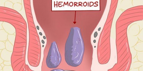 Utiliser l'hamamélis pour traiter les hémorroïdes