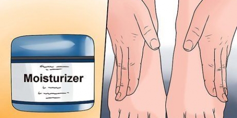 Traiter l'eczéma d'hiver